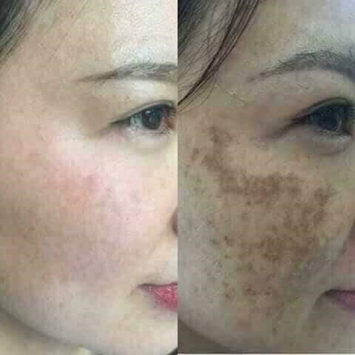 Hình ảnh khách hàng trước và sau khi điều trị tại Vanus