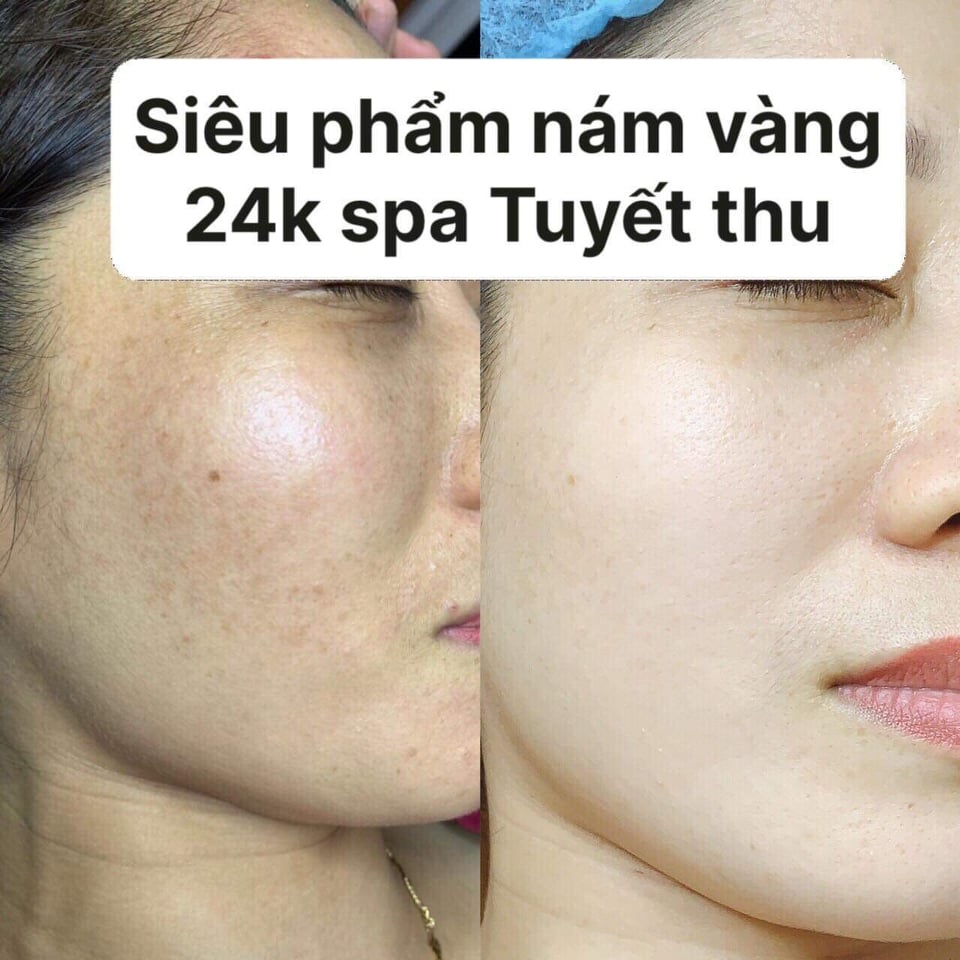 Hình ảnh khách sau khi điều trị tại Spa Tuyết Thu