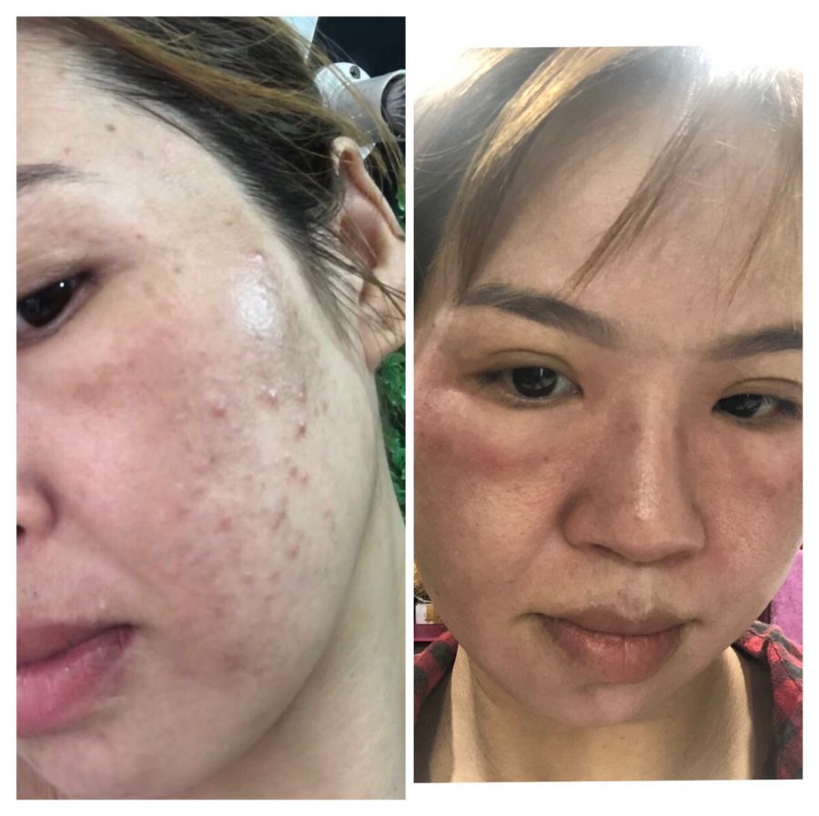 Làn da trước và sau khi điều trị tại Dr.Ánh