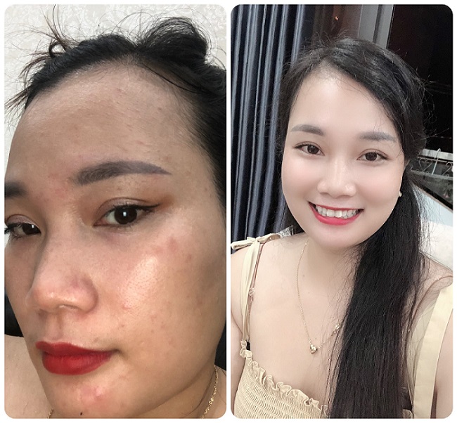 Sự thay đổi ngoạn mục sau khi chị sử dụng sản phẩm Vân Thành Cosmetics