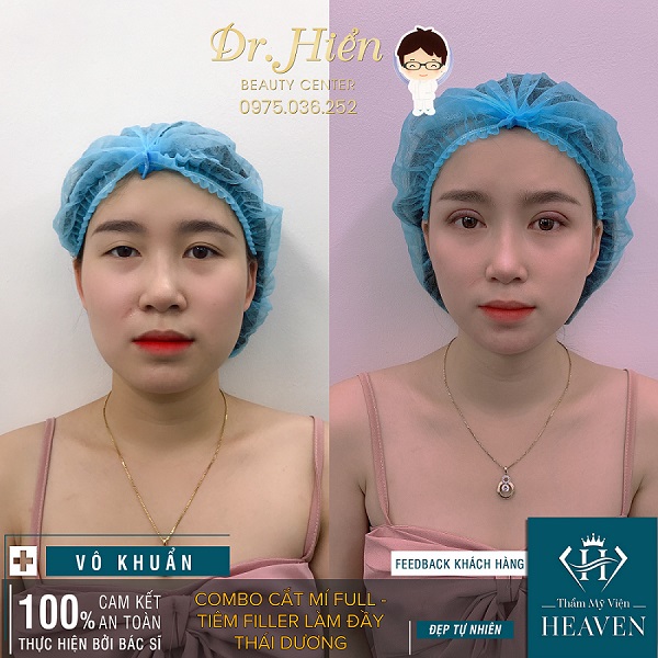 Khách hàng làm combo cắt mí - tiêm filler - làm đầy thái dương 
