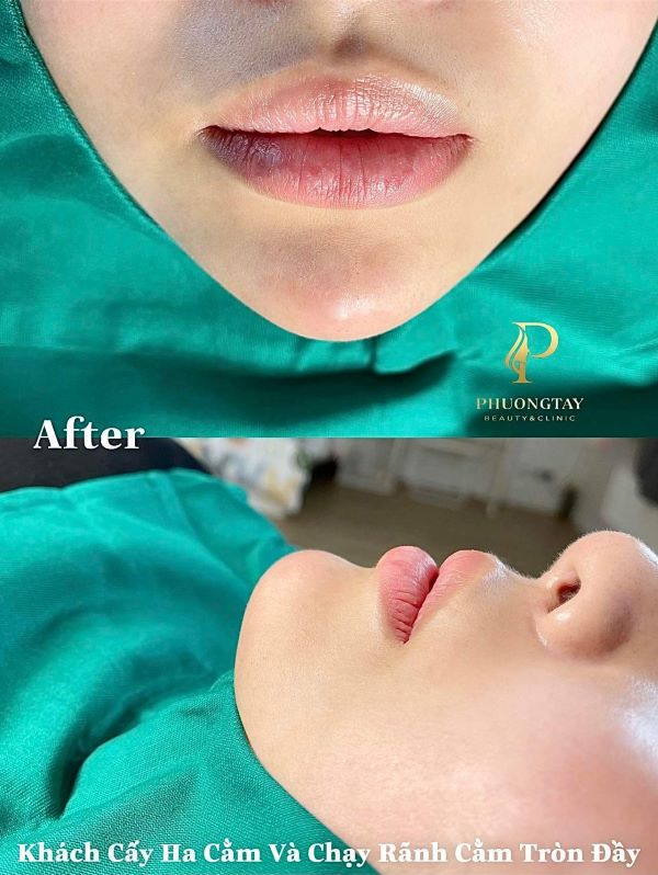 Kết quả trước và sau khi khách Phương Tây Beauty cây Ha cằm và chạy rãnh cằm tròn đầy