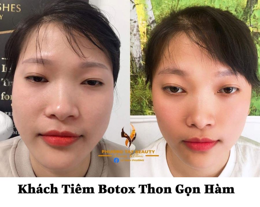 Kết quả trước và sau khi khách tiêm botox thon gọn hàm